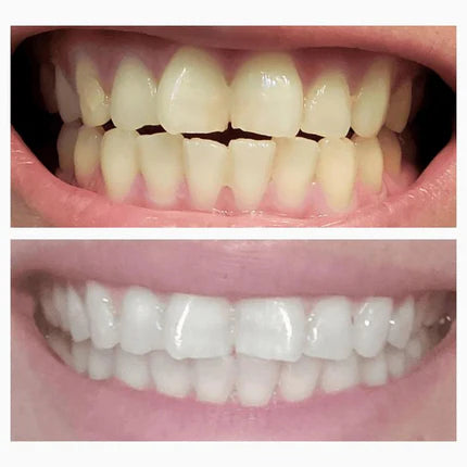 Glowing Teeth Whitening Pen