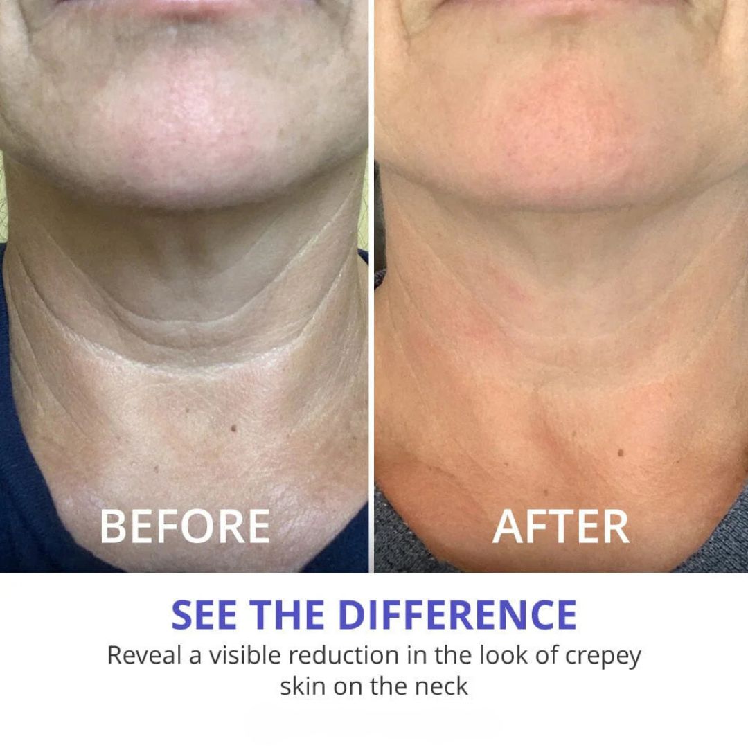 Youthful Neck Tightener